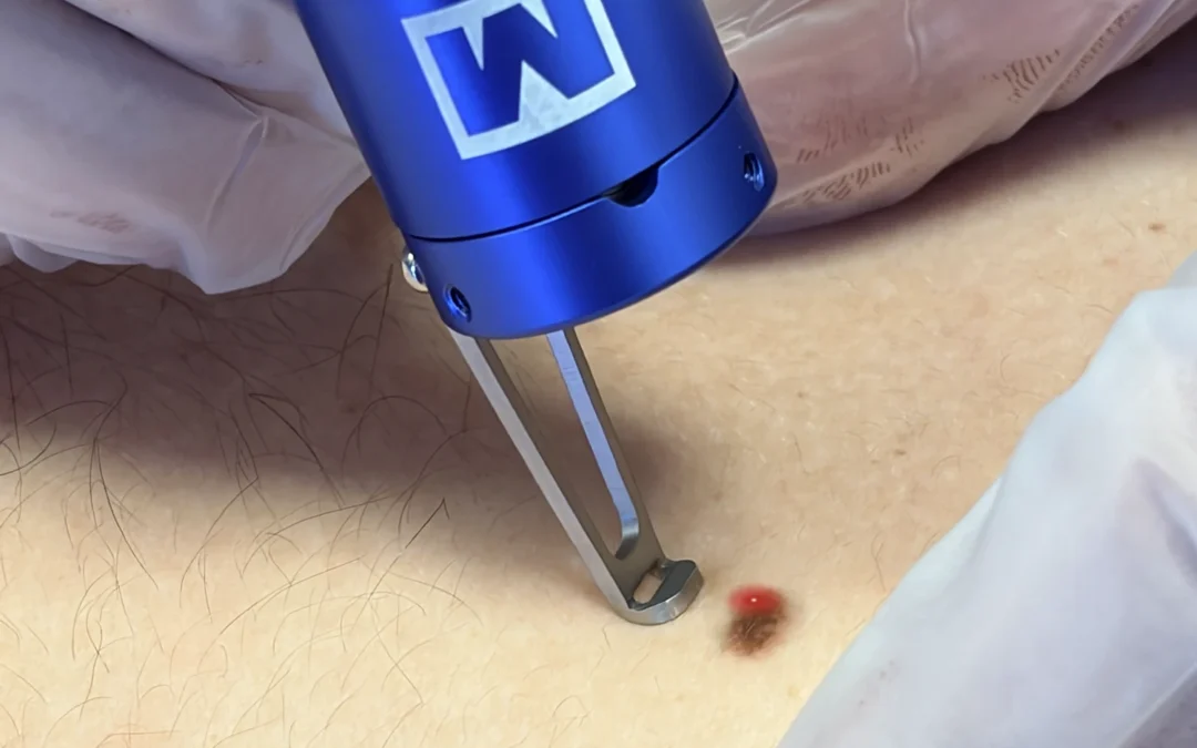 Como funciona un laser azul