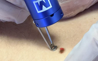 El F.A.Q. completo sobre el Láser Azul