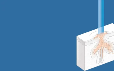 Láser azul en la lucha contra el acné